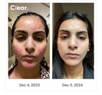 Ahana's documented skin journey from December 2023 to December 2024