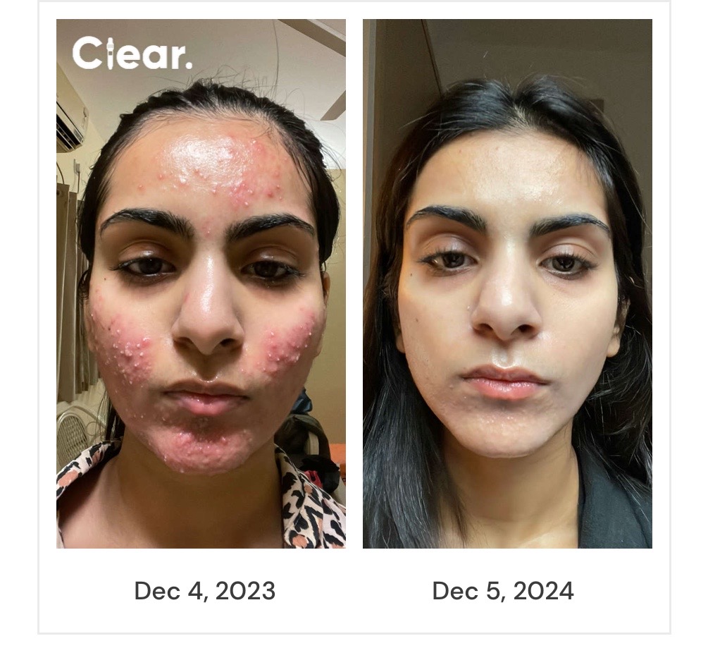 Ahana's documented skin journey from December 2023 to December 2024