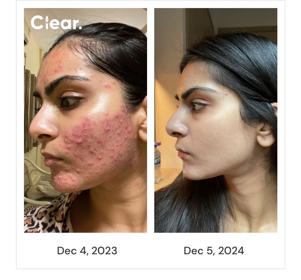 Left profile from Ahana's documented skin journey, December 2023 to December 2024