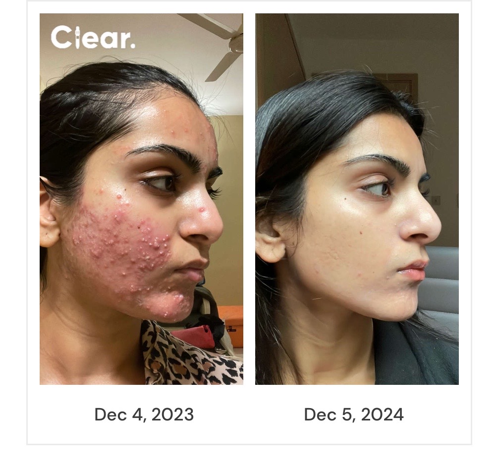 Right profile from Ahana's documented skin journey, December 2023 to December 2024